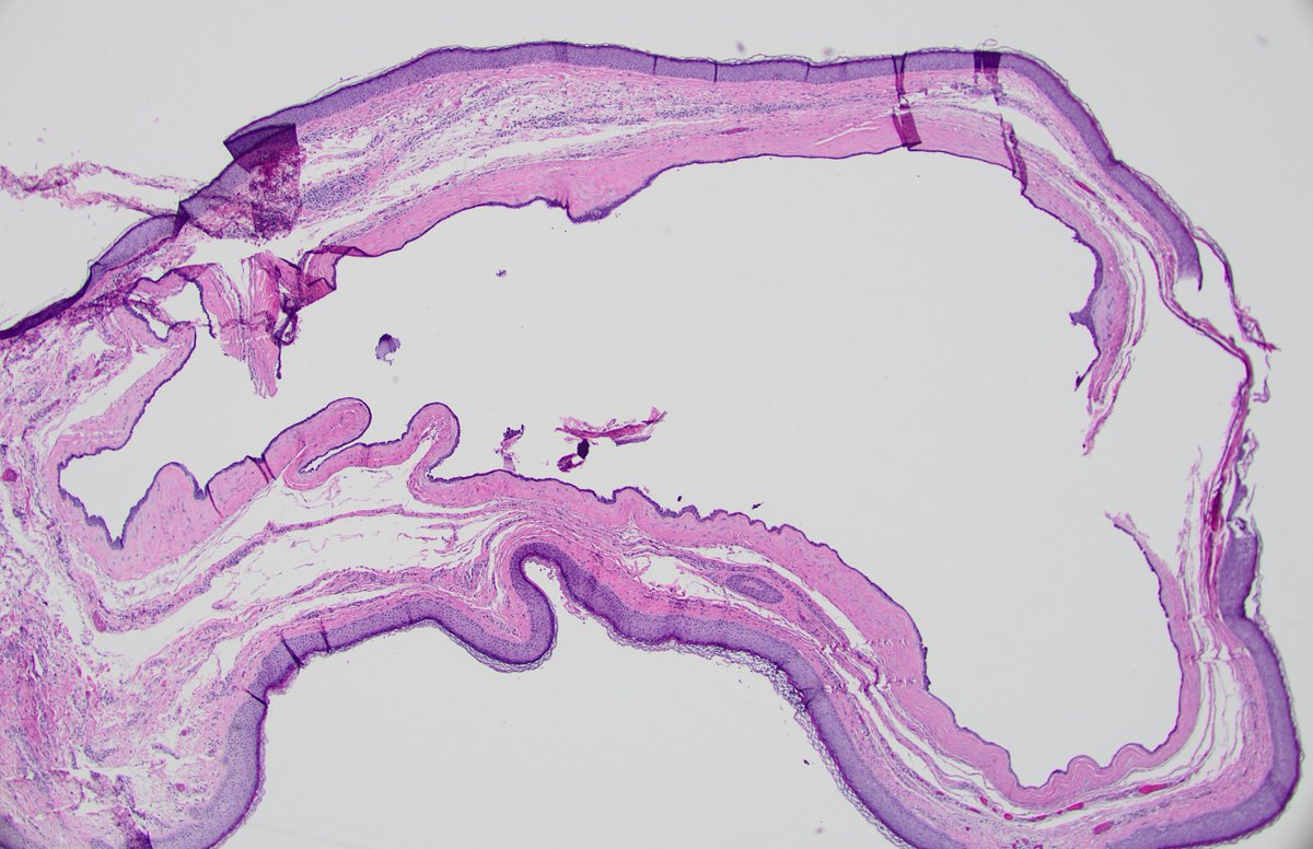 dgbrackett's tweet photo. Good example of a hidrocystoma, I think!
(lateral canthus lesion, also clinically favored to be hidrocystoma)
#eyepath #generalpath https://t.co/MbZsVq2Vsn