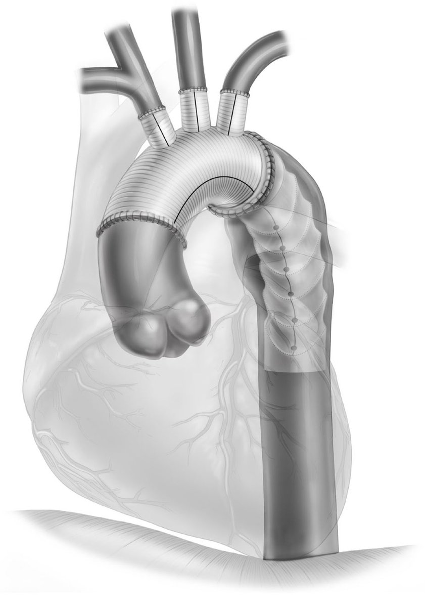Surgical Strategies in Reoperation of the Proximal Aorta and Arch for Patients with Previous FET 🫀📑

Open Access: mdpi.com/2077-0383/13/1… 

<a href="/JCM_MDPI/">JCM MDPI</a> <a href="/Dim_Magouliotis/">Dimitrios Magouliotis, MD, PhD, MSc</a>