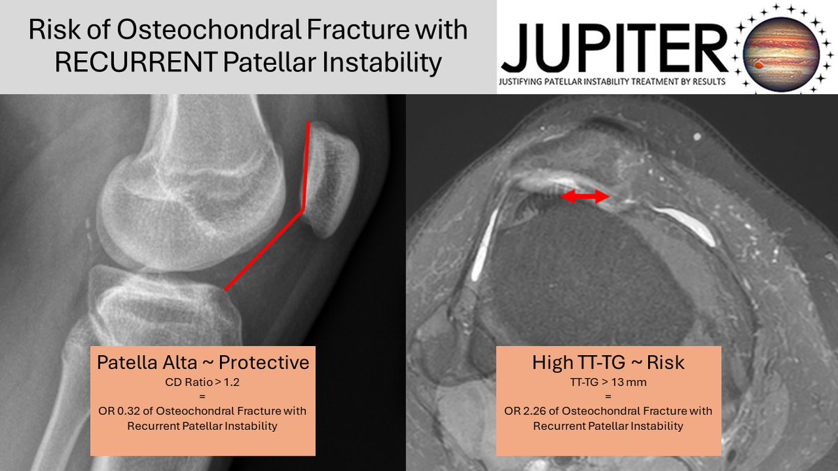 Risk factors for recurrent patellar instability have been well documented. However, data from JUPITER has identified that patella alta (CDI &gt; 1.2) may be protective against osteochondral fractures if recurrent patellar instability occurs while a TT-TG of &gt; 13 mm is a risk factor.