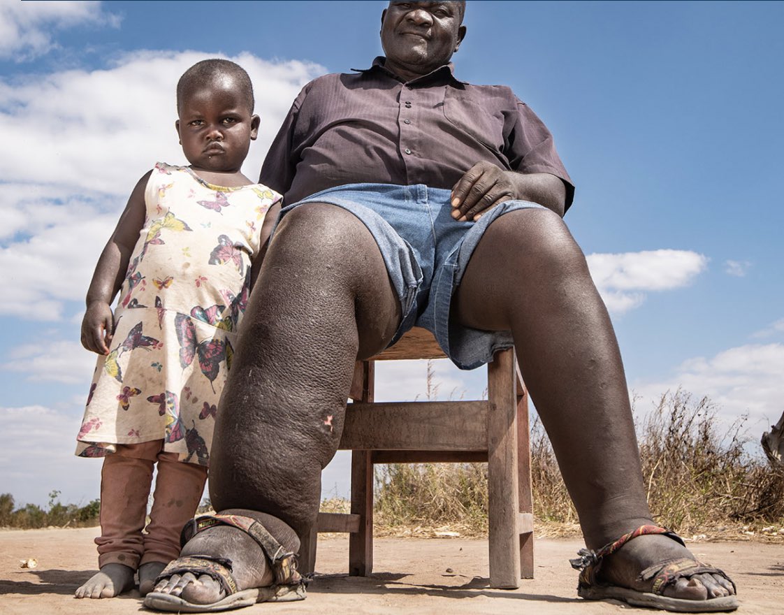 zizelle_'s tweet photo. When I was a child, my favorite uncle had elephantiasis.

We all thought he stepped on ‘juju’ and the adults did what they could, while we watched on.

Unfortunately, he died due to complications.

Nobody would’ve believed it was transmitted by mosquitoes.

Open thread… https://t.co/McymUaOjug