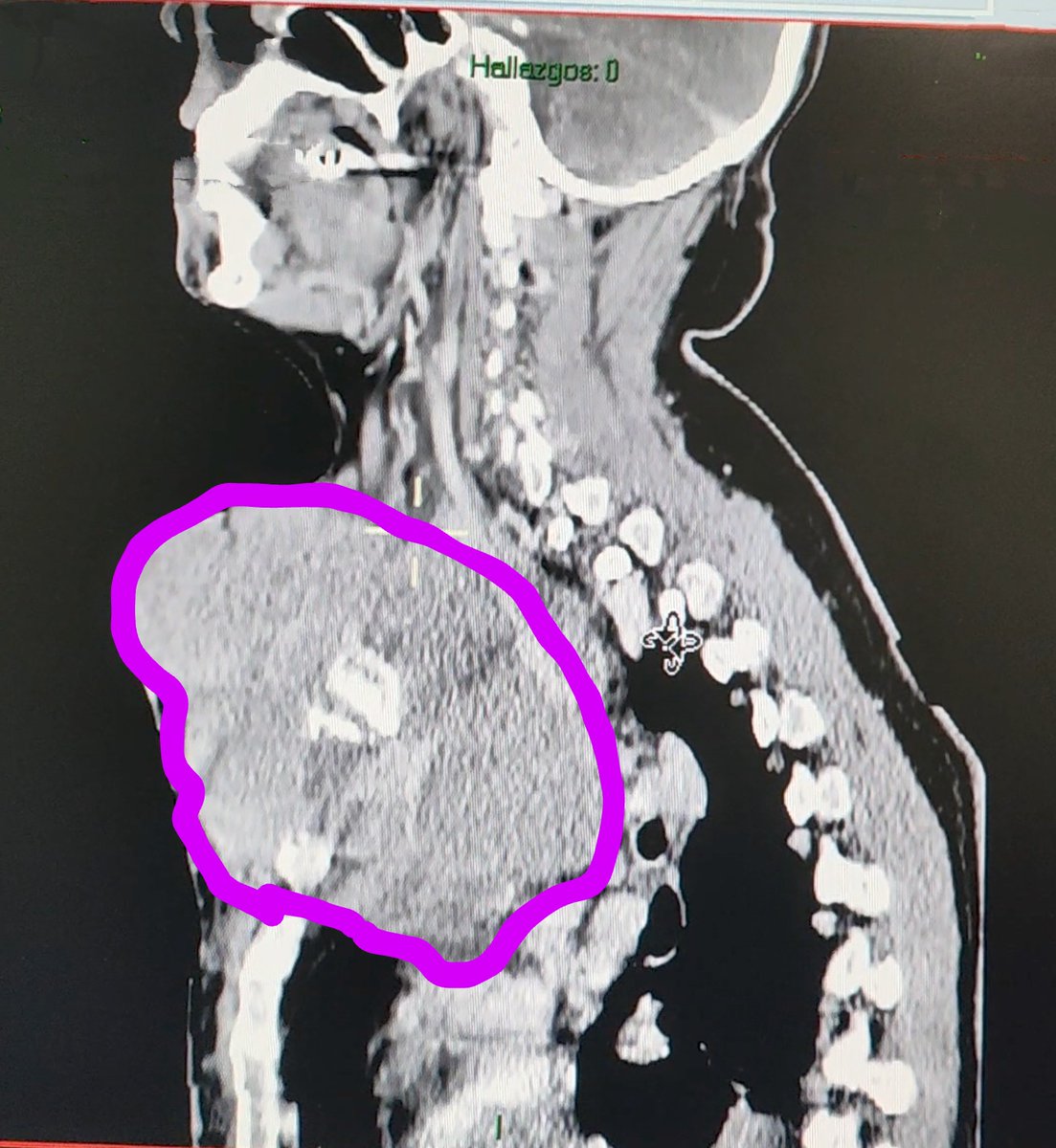 ballantines84's tweet photo. Síndrome de vena cava
Angioplastia y colocación de stent
Apegandonos a la propuesta del checklist en vía aerea difícil en el paciente oncologico
@incanMX 
@SMAOANESTONCO https://t.co/rLl2DYbqKz
