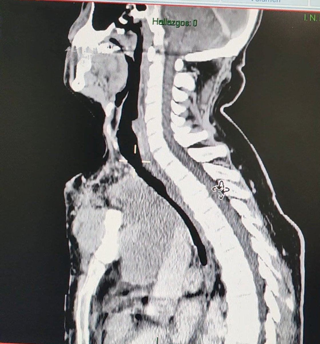 ballantines84's tweet photo. Síndrome de vena cava
Angioplastia y colocación de stent
Apegandonos a la propuesta del checklist en vía aerea difícil en el paciente oncologico
@incanMX 
@SMAOANESTONCO https://t.co/rLl2DYbqKz