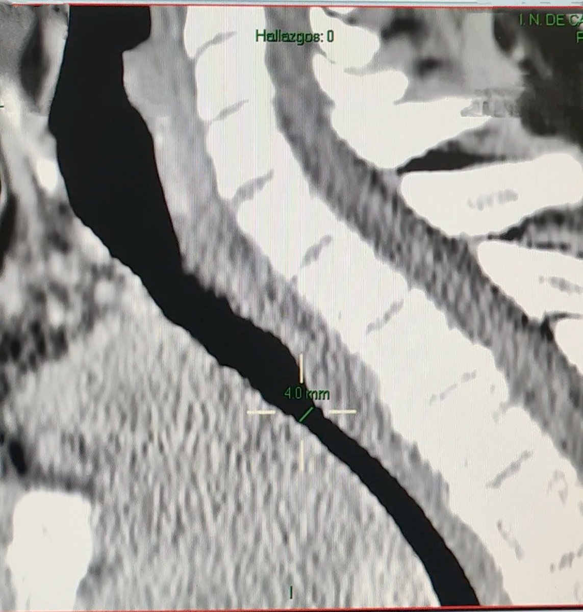 ballantines84's tweet photo. Síndrome de vena cava
Angioplastia y colocación de stent
Apegandonos a la propuesta del checklist en vía aerea difícil en el paciente oncologico
@incanMX 
@SMAOANESTONCO https://t.co/rLl2DYbqKz