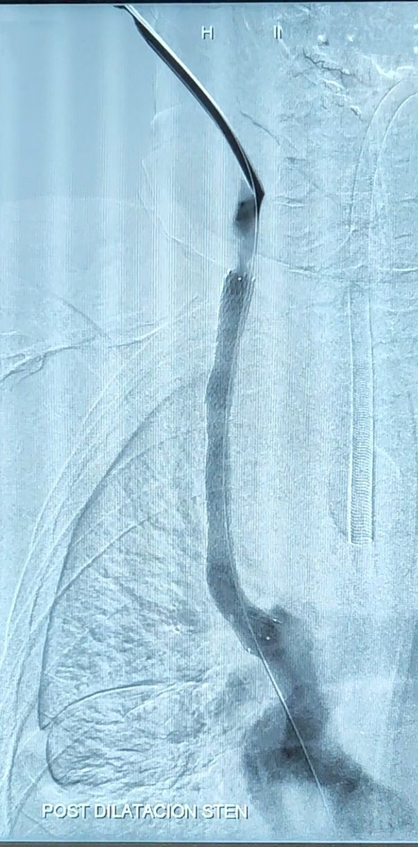 ballantines84's tweet photo. Intubación con paciente despierto
Ultiv 2.3 ng/ml
Superando el reto oncologico https://t.co/lliEfookN3