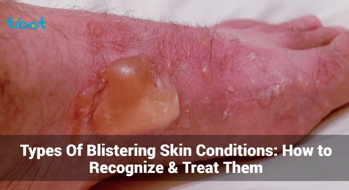 tibot_ai's tweet photo. Blistering Skin Conditions: How to Recognize &amp; Treat Them
Struggling with blisters and unsure what’s causing them? Discover (https://t.co/XoBZgyyuaH) how to identify and treat various blistering skin conditions with our comprehensive guide!
#BlisteringSkin #SkinHealth #HealthTips https://t.co/TQ3yJZFPky