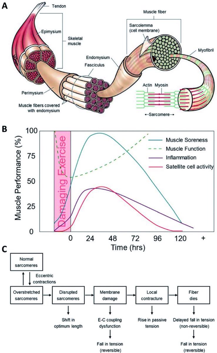 Exercise-induced muscle injuries and related mechanisms👇🏼

A) Structure of skeletal muscle
B) muscle performance after exercise-induced muscle injury
C) mechanism of exercise-induced muscle injuries

#muscle #injury #exercise 

pubs.rsc.org/en/content/art…