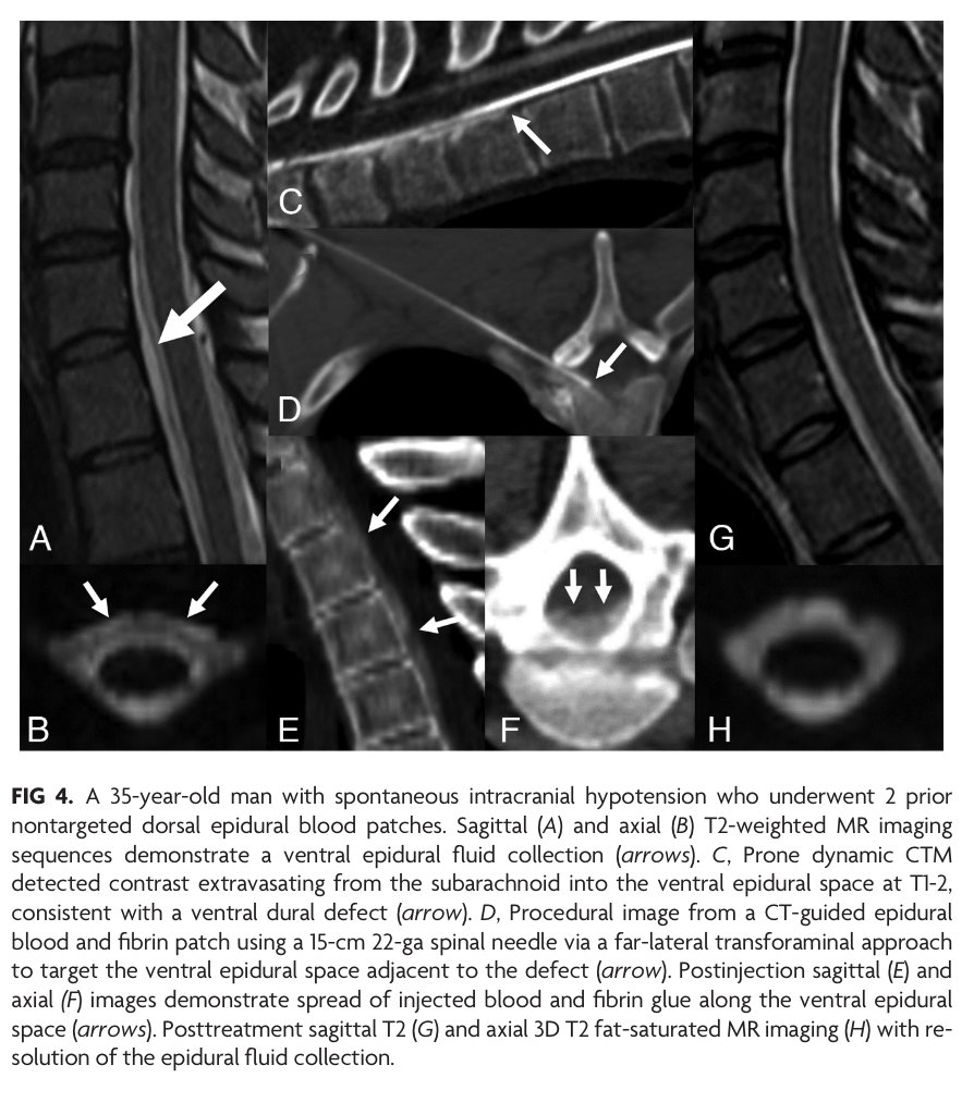 AJNR (@theajnr) on Twitter photo "Perspectives from the Inaugural “Spinal CSF Leak: Bridging the Gap” Conference: A Convergence of Clinical and Patient Expertise"
doi.org/10.3174/ajnr.A…
#OpenAccess #EditorsChoice #CSFLeak <a href="/AndrewCallenMD/">Andrew L Callen MD</a> "Perspectives from the Inaugural “Spinal CSF Leak: Bridging the Gap” Conference: A Convergence of Clinical and Patient Expertise"
doi.org/10.3174/ajnr.A…
#OpenAccess #EditorsChoice #CSFLeak <a href="/AndrewCallenMD/">Andrew L Callen MD</a>