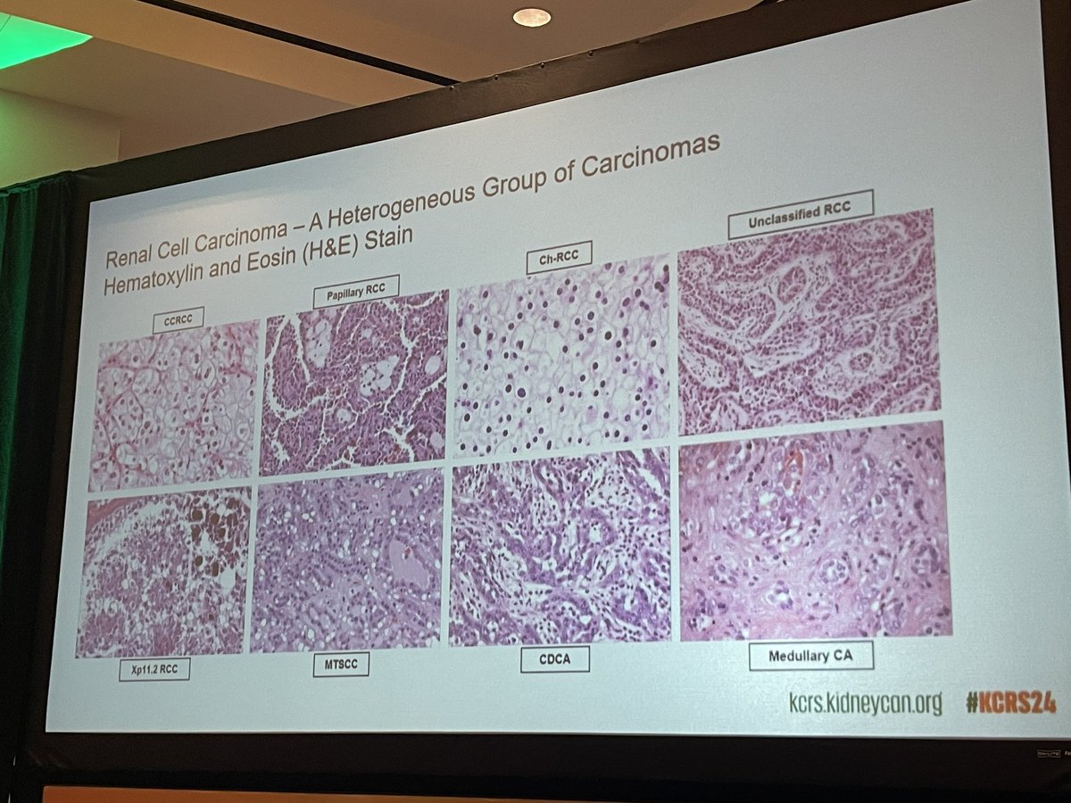 neerajaiims's tweet photo. Surgical Pathology Toolbox and Technological Advances to Solve Kidney Cancer Problems👇Excellent talk by @MichelleDunno17 @BrighamWomens on the pathology diagnosis of RCC variants👇#kidneycancer #KCRS24 @kidneycan Excellent job by chairs @drmehrarohit @PayalKapur5 @DrChoueiri https://t.co/uJGqwfeNlx