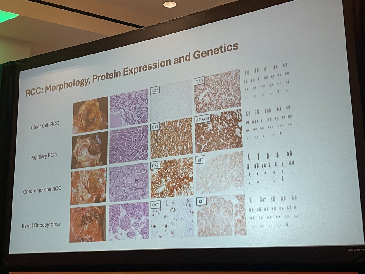 neerajaiims's tweet photo. Surgical Pathology Toolbox and Technological Advances to Solve Kidney Cancer Problems👇Excellent talk by @MichelleDunno17 @BrighamWomens on the pathology diagnosis of RCC variants👇#kidneycancer #KCRS24 @kidneycan Excellent job by chairs @drmehrarohit @PayalKapur5 @DrChoueiri https://t.co/uJGqwfeNlx