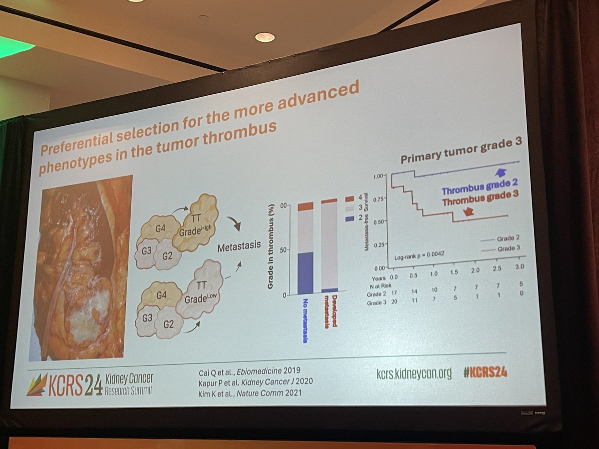neerajaiims's tweet image. Prognostic and Predictive Biomarkers in #kidneycancer Very insightful talk by @PayalKapur5 @UTSWMedCenter 👉Tumor thrombus grading predicts metastasis free survival better than primary RCc grading &amp;amp; more👇#KCRS24 @kidneycan @DrChoueiri @JBrugarolas @HHammersMD