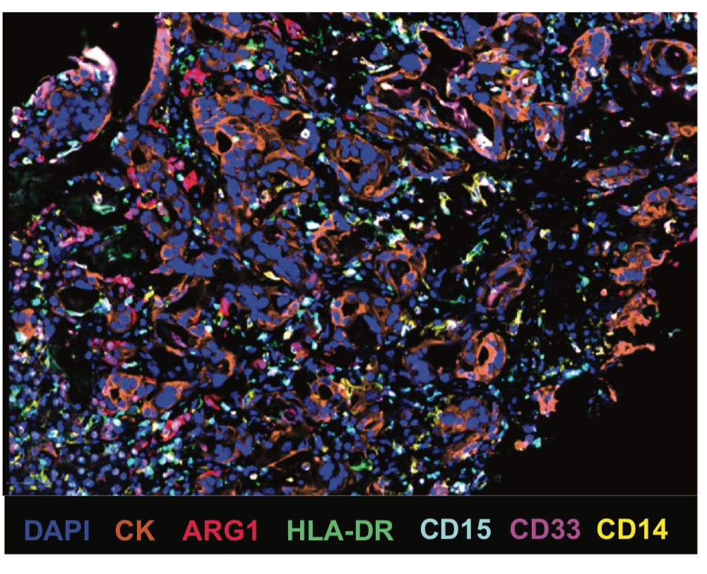 Anirban Maitra (@aiims1742) on Twitter photo #OpenAccess in <a href="/CIR_AACR/">Cancer Immunology Research</a>
Blockade of IL-1β and PD-1 with combination chemotherapy reduces systemic myeloid suppression in metastatic #PancreaticCancer with heterogeneous effects in the tumor
aacrjournals.org/cancerimmunolr…
A phase 1 trial (co-led by <a href="/DanaFarber_Hale/">Hale Family Center For Pancreatic Cancer Research</a> & <a href="/nyulangone/">NYU Langone Health</a>) with #OpenAccess in <a href="/CIR_AACR/">Cancer Immunology Research</a>
Blockade of IL-1β and PD-1 with combination chemotherapy reduces systemic myeloid suppression in metastatic #PancreaticCancer with heterogeneous effects in the tumor
aacrjournals.org/cancerimmunolr…
A phase 1 trial (co-led by <a href="/DanaFarber_Hale/">Hale Family Center For Pancreatic Cancer Research</a> & <a href="/nyulangone/">NYU Langone Health</a>) with