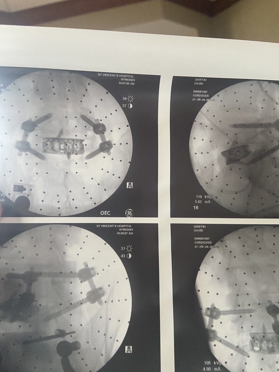 Got some new hardware put in my back this past Monday. Going to be a couple months before I’m back to normal.