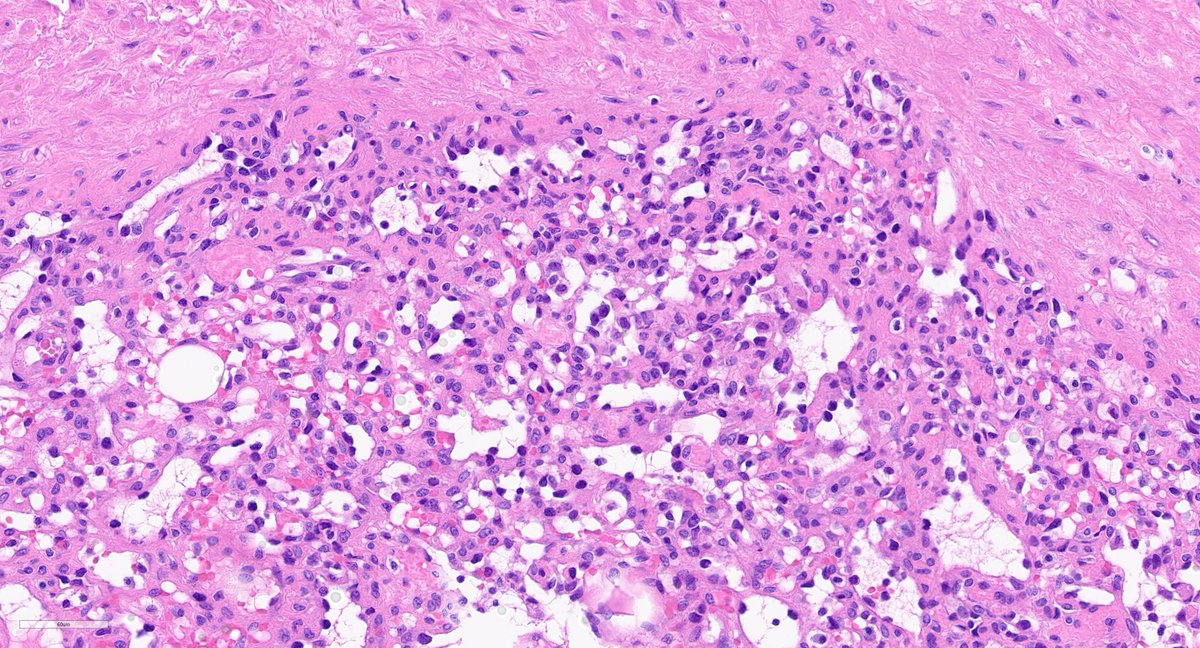 KyleDPerryMD's tweet photo. Intravascular lobular capillary hemangioma can sometimes exhibit hobnail morphology or some nuclear atypia which can cause concern for a more aggressive vascular tumor. #BSTPath, #UmichPath, #BSTpathGoBlue, #dermpath