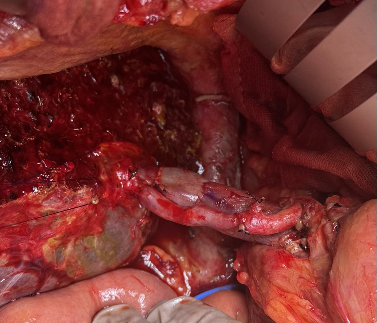 Left side Dominant Hilar Cholangio required RHA resection and reverse SVG to junction of RA And RP HA, unable to transpose left HA. PV resection with LRV graft from PV to the junction of RA and RP PV.