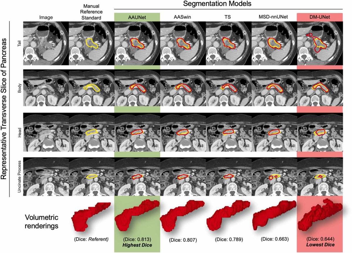 Guess what: that dice score isn't giving you the whole picture!

Let's go over my recent paper where we look at common CT imaging &amp; patient characteristics and how they affect segmentation quality in pancreatic segmentation tasks.

doi.org/10.1016/j.acra…