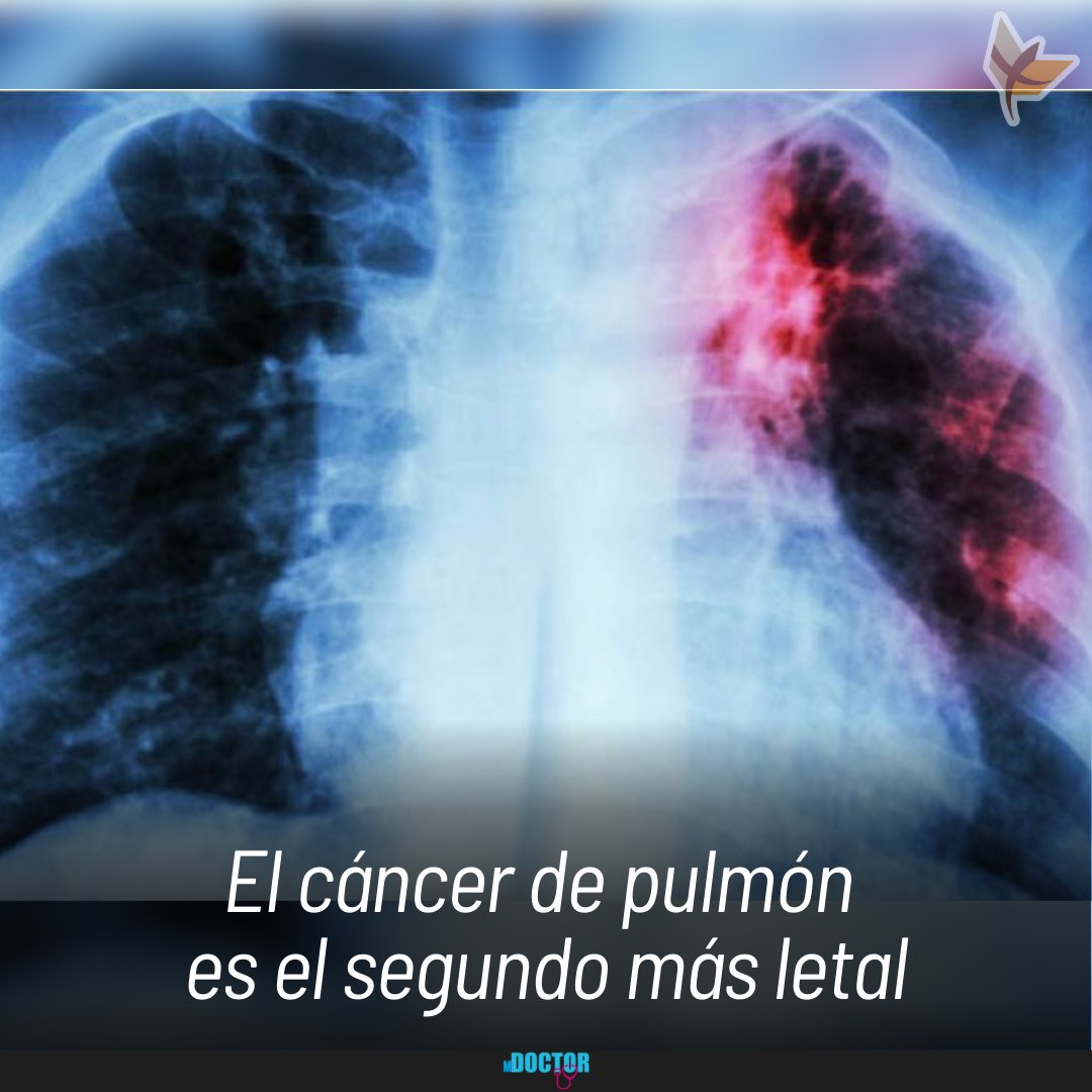 correodelsurcom's tweet photo. Todo lo que necesitas saber sobre el cáncer de pulmón y los tratamientos, entre ellos la cirugía de pulmón que, cuando es recomendada, ofrece expectativas de vida al paciente. Lee la nota publicada en en #MIDOCTOR, suplemento de salud que circula los domingos junto a CORREO DEL SUR.
AUSPICIADORES:
HANSA - Soluciones Médicas
HP Medical
Colegio Médico Chuquisaca
#SucreReferenteMedico