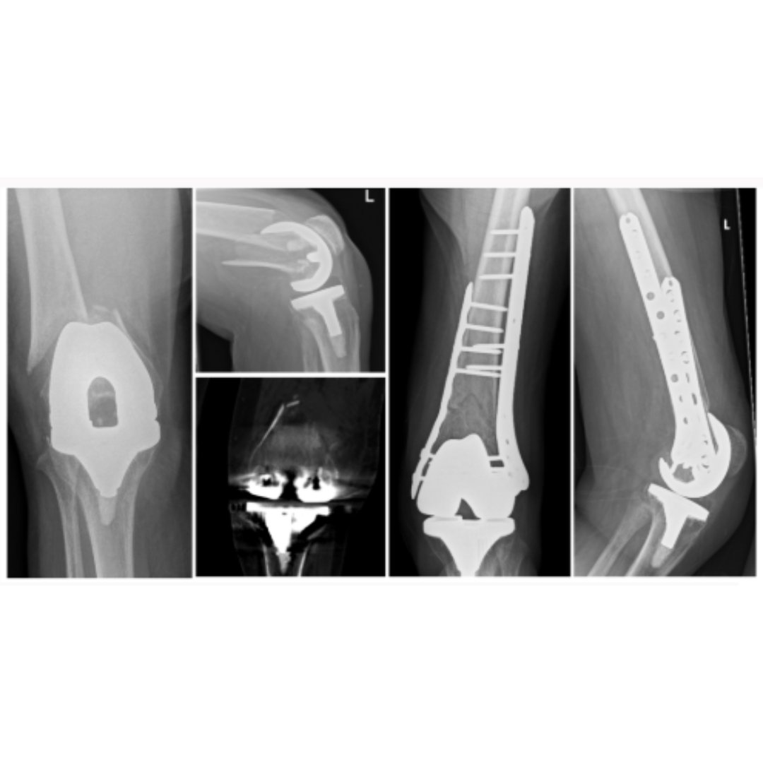 Bone & Joint Open (@bonejointopen) on Twitter photo Double plating resulted in a more anatomical fracture reduction compared to single plating. This technique can be suitable in cases that were previously treated with distal femoral arthroplasty.
#Knee #BJO #Fracture <a href="/EdinOrthopaedic/">Edinburgh Orthopaedics</a> <a href="/EdinburghKnee/">Chloe EH Scott</a>
ow.ly/JHxf50SqRly Double plating resulted in a more anatomical fracture reduction compared to single plating. This technique can be suitable in cases that were previously treated with distal femoral arthroplasty.
#Knee #BJO #Fracture <a href="/EdinOrthopaedic/">Edinburgh Orthopaedics</a> <a href="/EdinburghKnee/">Chloe EH Scott</a>
ow.ly/JHxf50SqRly