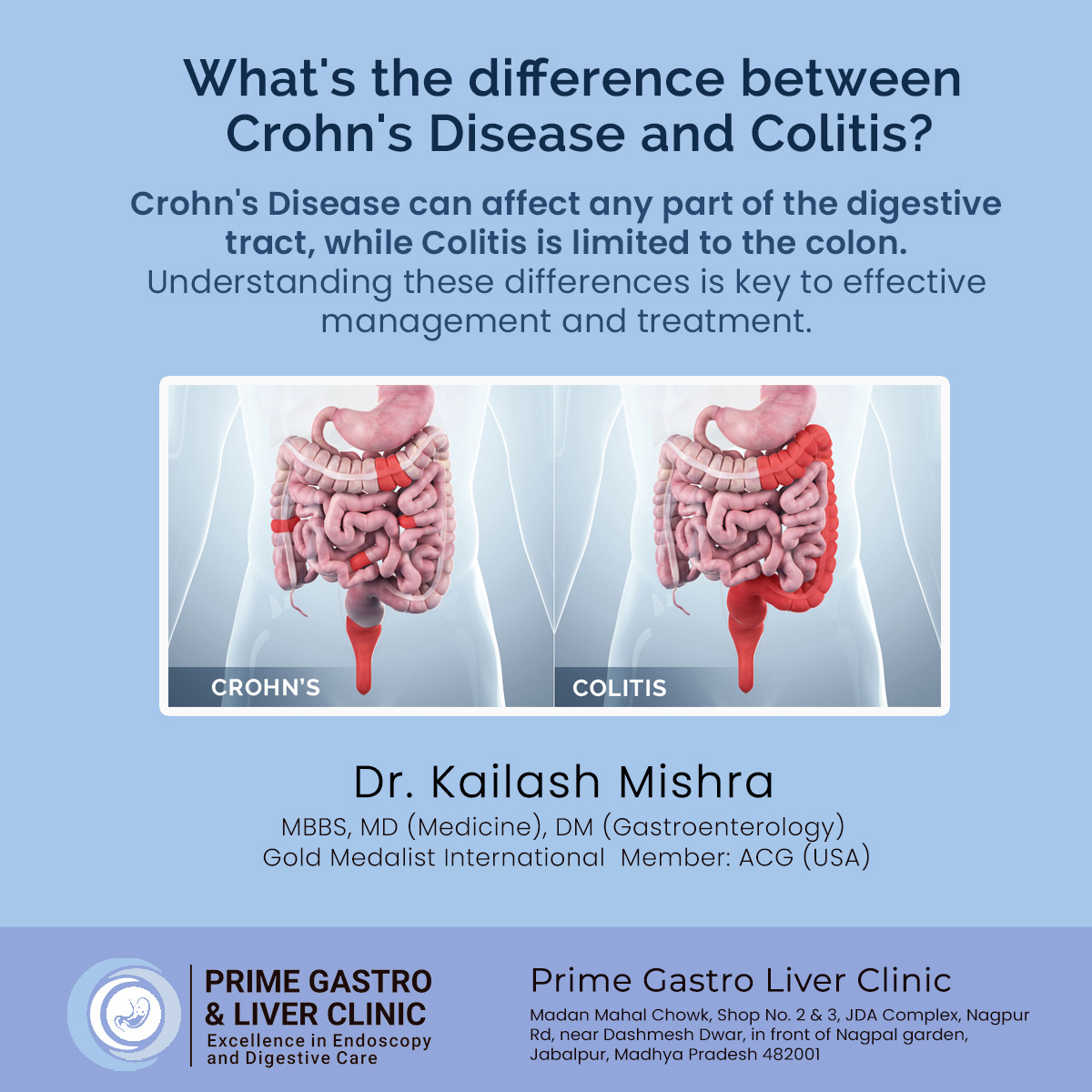 drkailashmishra's tweet image. #Crohnsdisease primarily affects the #smallintestines and the commencement of the large intestine or the colon, although it can occur anywhere in your #digestivetract, from the mouth to the #anus. 

Read More: lnkd.in/dnVx2Rgf, Call 9826014491
#Colitis #gastrointestinal