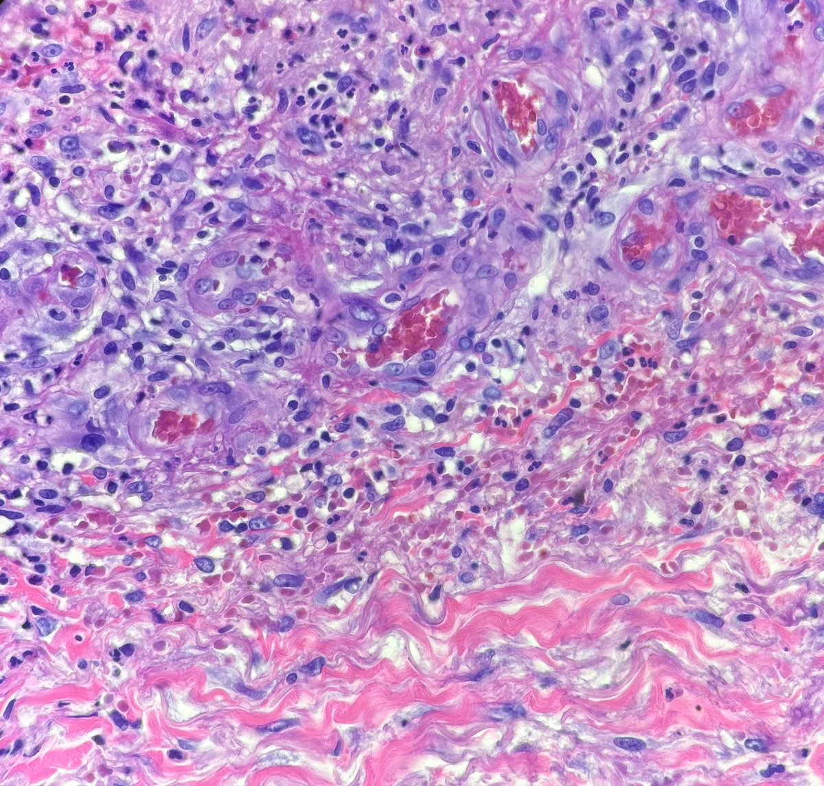 BSchmidtDpath's tweet image. #dermpath #pathology #dermatology 

Recent case I had of cutaneous involvement by known granulomatosis with polyangiitis. These were photos I shared with the clinician who was concerned for infection.