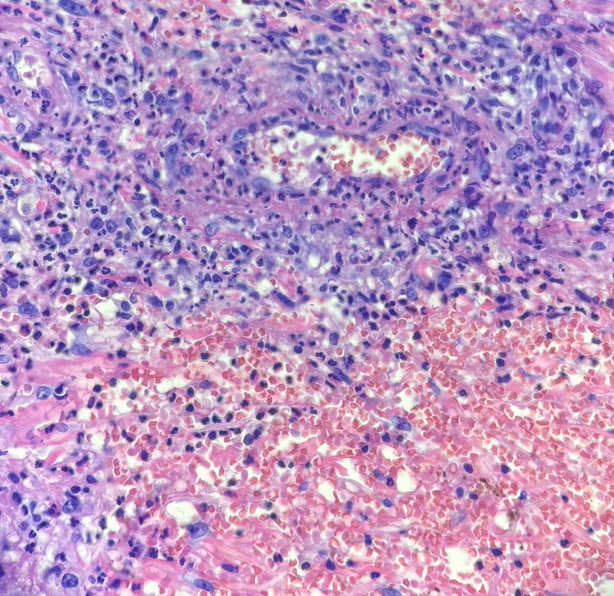 BSchmidtDpath's tweet image. #dermpath #pathology #dermatology 

Recent case I had of cutaneous involvement by known granulomatosis with polyangiitis. These were photos I shared with the clinician who was concerned for infection.
