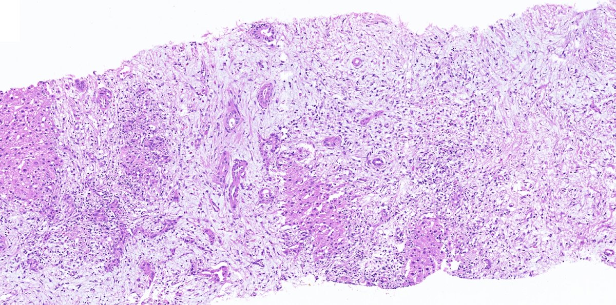 drmehmetozcan's tweet photo. A 43-year-old female patient presented with jaundice. MRI is compatible with PSK, and there is also a suspicious mass image with a diameter of 2.5 cm (cholangio ca?). What are your thoughts? #liverpath @liverpath @RaulSGonzalezMD @ALBoothMD @TheKarenPinto @KristenStashek https://t.co/Hlpbts6cG2
