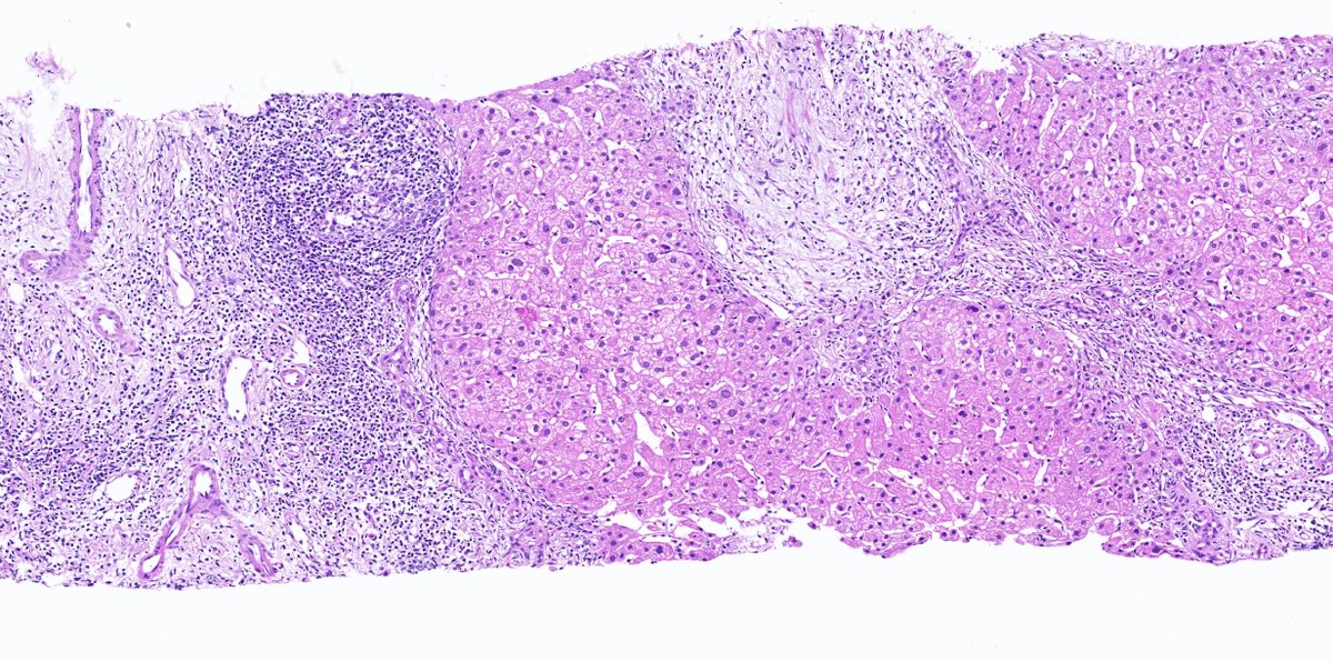 drmehmetozcan's tweet photo. A 43-year-old female patient presented with jaundice. MRI is compatible with PSK, and there is also a suspicious mass image with a diameter of 2.5 cm (cholangio ca?). What are your thoughts? #liverpath @liverpath @RaulSGonzalezMD @ALBoothMD @TheKarenPinto @KristenStashek https://t.co/Hlpbts6cG2