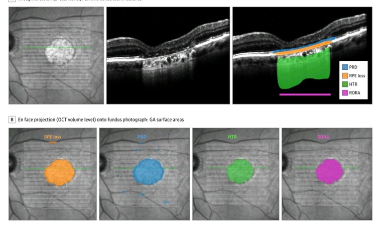 Dun Jack Fu (@dunjackfu) on Twitter photo Pegcetacoplan associated with slower growth of photoreceptor degeneration (PRD), RPE-loss, PRD in isolation, and RPE and Outer Retinal Atrophy.
Our analysis of automatically-segmented quantitative OCT biomarkers out in <a href="/JAMAOphth/">JAMA Ophthalmology</a> based on OAKS & DERBY <a href="/ApellisPharma/">Apellis Pharma</a> data. Pegcetacoplan associated with slower growth of photoreceptor degeneration (PRD), RPE-loss, PRD in isolation, and RPE and Outer Retinal Atrophy.
Our analysis of automatically-segmented quantitative OCT biomarkers out in <a href="/JAMAOphth/">JAMA Ophthalmology</a> based on OAKS & DERBY <a href="/ApellisPharma/">Apellis Pharma</a> data.