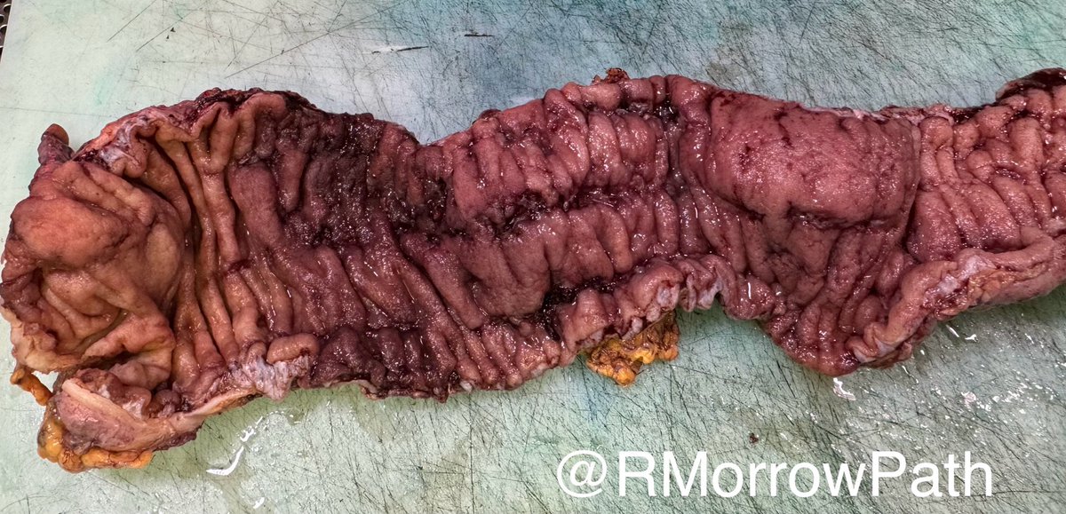 RMorrowPath's tweet photo. 📕what’s going on in this colon?
📗what buzz terms are used to describe the mucosal changes?
📘how would you sample it?
#qualitypathology starts with quality macros #grosspath
#pathtwitter #gitpath https://t.co/8m0kiqVeg8