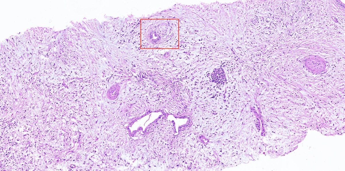 AnthonyWHChan's tweet photo. @drmehmetozcan @Hopkins_GI_Path @DoraGIPath @WendyFrankelMD @Mvgs1706 @pezhouh @NigarAKhurram @ggchen_MD @rondell_graham @DibsonG @Dr_DR_Cells @zucchiatti_ @pooja_dhorajiya @UKLiverPath @LiverPath_HPHS Thank you for tagging me on this challenging case! There is another focus (maybe just another level) of perineural invasion. I strongly believe that it is CCA because of irregular glandular contour, cytological atypia, and PNI. However... https://t.co/wVQeMmuIIY