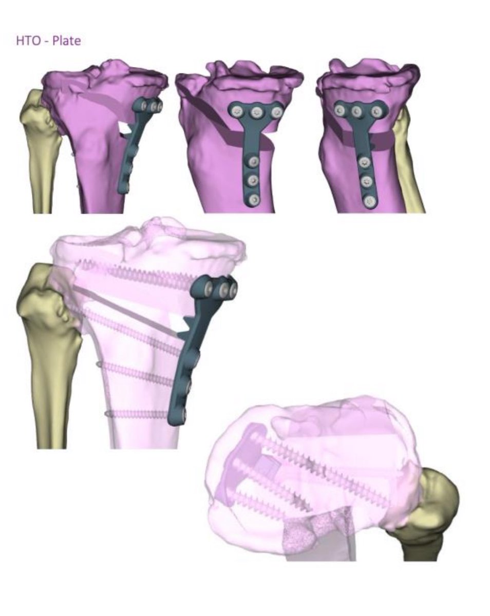 Guru Kholagde (@gurukholgade) on Twitter photo Delighted to announce first 2 Custom made Osteotomies performed at KGH Theatres by Mr Ahmed Ali and Mr Asif Parkar. We are the 1st & only Hospital in North East London and Essex to perform these procedures.<a href="/AsifParkar12/">Asif Parkar</a> <a href="/dramalesh/">π πΈπππππ€π</a> <a href="/lucy_gladman1/">Lucy Gladman</a> <a href="/joycehartzenbe1/">Joyce Hartzenberg</a> <a href="/DivNhs/">Surgery Anaesthesia Critical Care Group BHR NHS π</a> Delighted to announce first 2 Custom made Osteotomies performed at KGH Theatres by Mr Ahmed Ali and Mr Asif Parkar. We are the 1st & only Hospital in North East London and Essex to perform these procedures.<a href="/AsifParkar12/">Asif Parkar</a> <a href="/dramalesh/">π πΈπππππ€π</a> <a href="/lucy_gladman1/">Lucy Gladman</a> <a href="/joycehartzenbe1/">Joyce Hartzenberg</a> <a href="/DivNhs/">Surgery Anaesthesia Critical Care Group BHR NHS π</a>