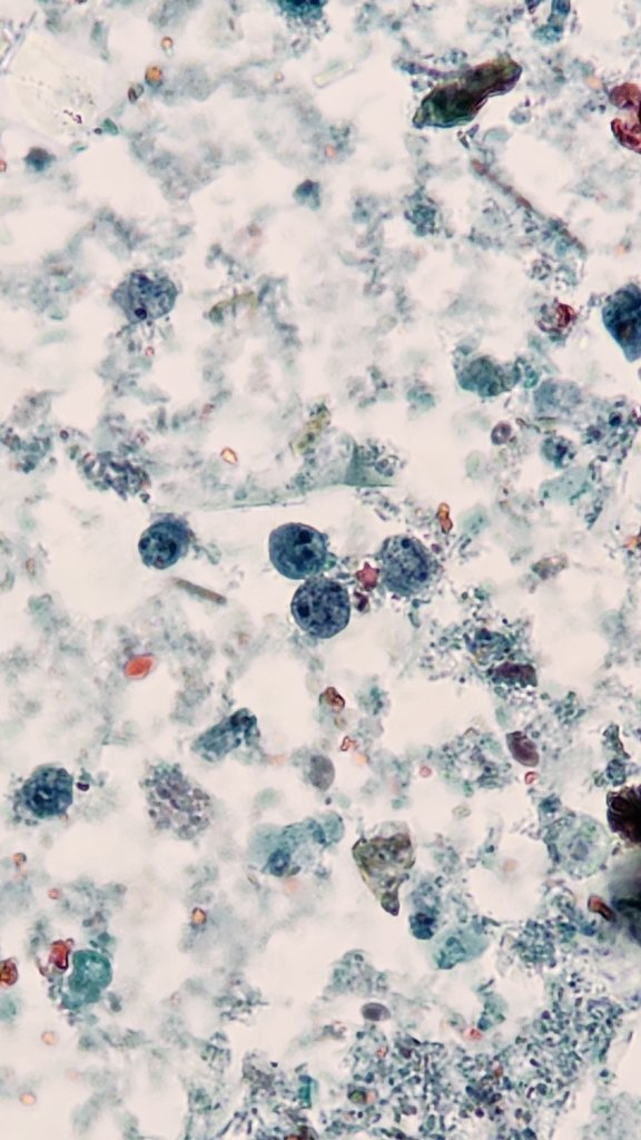 Marc Couturier PhD, D(ABMM) 🕷🦠🔬 (@parasite_power) on Twitter photo Friday, Funday. This is what we consider...a whole lot of Dientamoeba fragilis! Mostly binucleate forms with variably fragmented karyosomes.
#parasitology <a href="/ARUPLabs/">ARUP Laboratories</a> <a href="/ParasiteGal/">Bobbi Pritt, MD</a> Friday, Funday. This is what we consider...a whole lot of Dientamoeba fragilis! Mostly binucleate forms with variably fragmented karyosomes.
#parasitology <a href="/ARUPLabs/">ARUP Laboratories</a> <a href="/ParasiteGal/">Bobbi Pritt, MD</a>