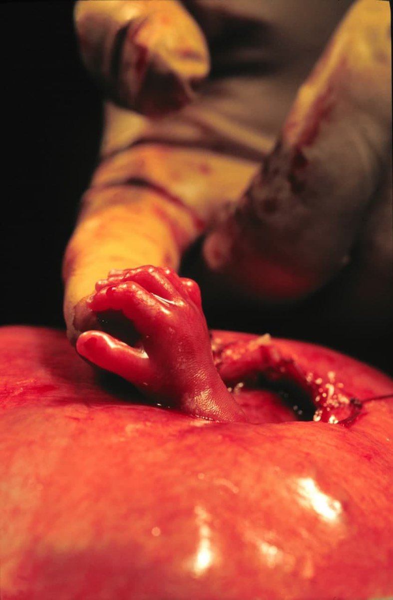 amanshailli's tweet photo. This image shows a fetal hand emerging from an incision during a surgical procedure, likely a fetal surgery or a cesarean section. Such images are iconic in illustrating medical interventions performed on a fetus while still in the womb. https://t.co/EMKEFgJMEO