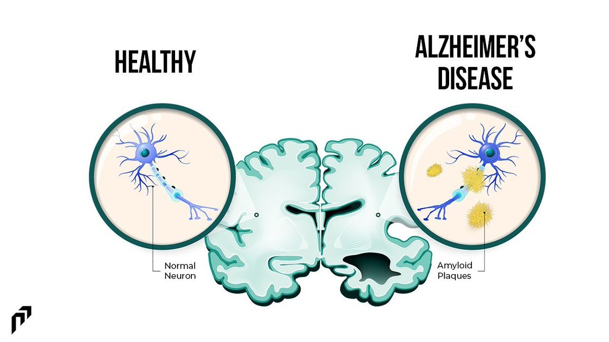 Reduces risk of Alzheimer's

Your brain is home to a protein called Amyloid-beta.

This protein cove...