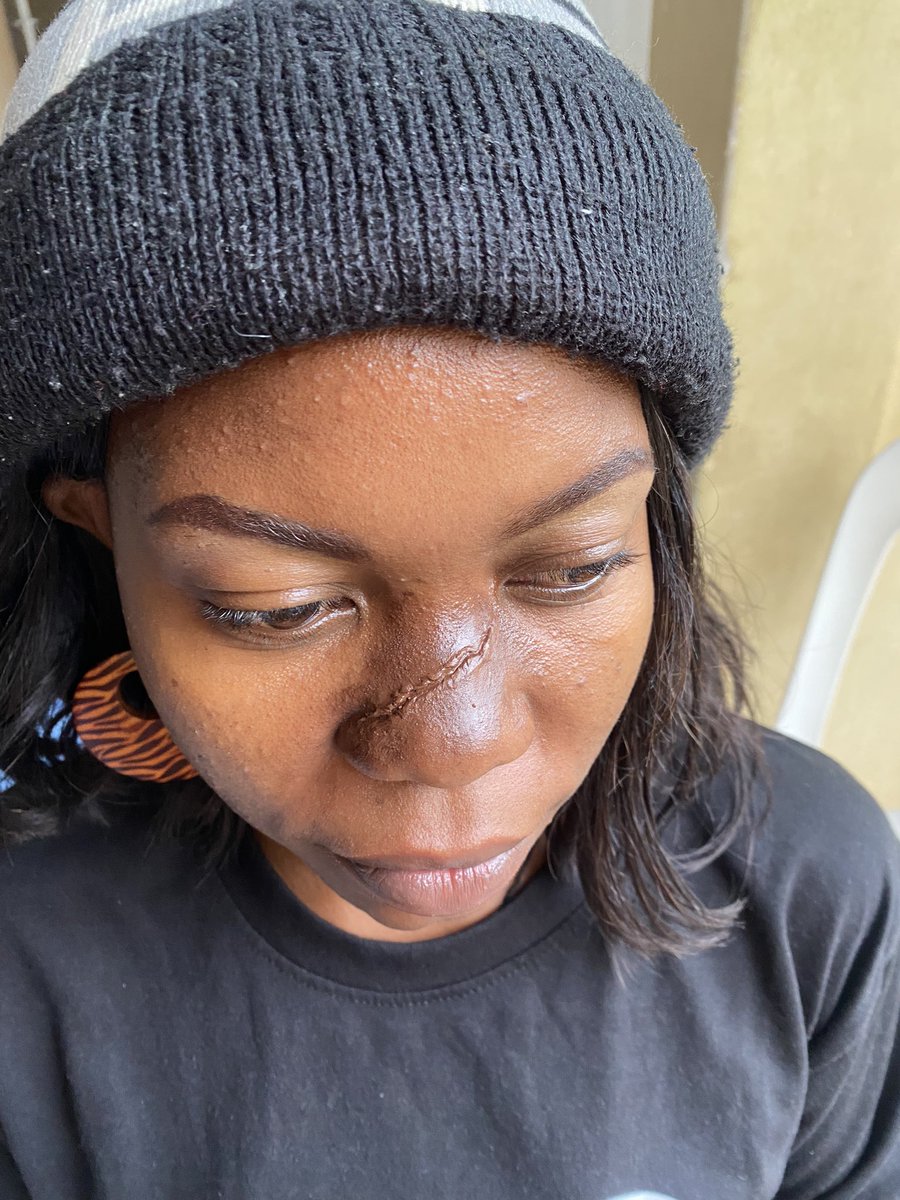 ENakaziba's tweet photo. Mentoring girls in the film makeup industry is important because it helps them gain valuable skills, knowledge, and confidence pursue a successful career in this field Of film makeup artistry
Student learning how to create #brokennose sfxmakeup look.
 #makeupclasses 
#filmmakeup https://t.co/Wa5s509kIh