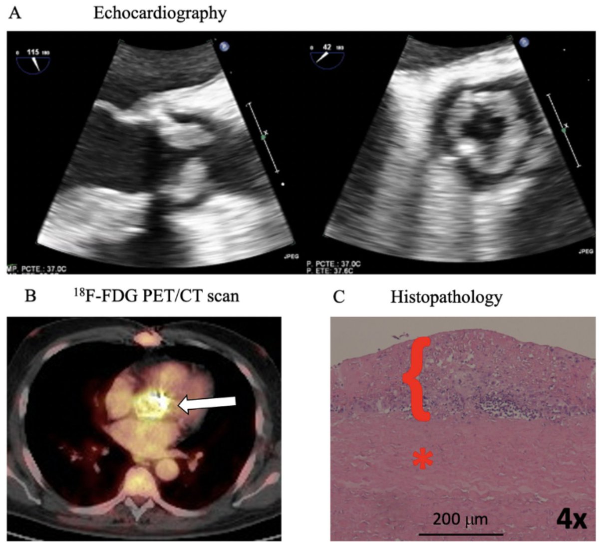 Fundación FIC (@fundacion_fic) on Twitter photo #Valvulitis: un nuevo criterio ecocardiográfico para el diagnóstico de #endocarditisInfecciosa de bioprótesis de válvula aórtica.
✍️Artículo de <a href="/pablozf0/">Pablo Zulet Fraile</a> <a href="/epozoosinalde/">Eduardo Pozo</a> <a href="/DoctordeAgustin/">Alberto de Agustin</a> <a href="/patmahia/">Patricia Mahia</a> et. al en <a href="/RevEspCardiol/">REC Publications</a>
📎acortar.link/IkgX2A #Valvulitis: un nuevo criterio ecocardiográfico para el diagnóstico de #endocarditisInfecciosa de bioprótesis de válvula aórtica.
✍️Artículo de <a href="/pablozf0/">Pablo Zulet Fraile</a> <a href="/epozoosinalde/">Eduardo Pozo</a> <a href="/DoctordeAgustin/">Alberto de Agustin</a> <a href="/patmahia/">Patricia Mahia</a> et. al en <a href="/RevEspCardiol/">REC Publications</a>
📎acortar.link/IkgX2A