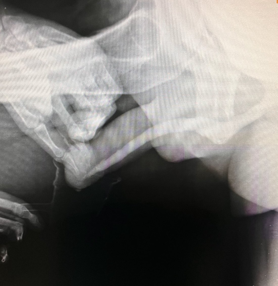 MauroMMeo's tweet photo. Successfully performed BMG urethroplasty with glandular preservation in a patient with stenosis of the urethral meatus and navicular fossa due to lichen sclerosus. #ReconstructiveUrology #BMG #LichenSclerosus https://t.co/gXQlcO9Hth