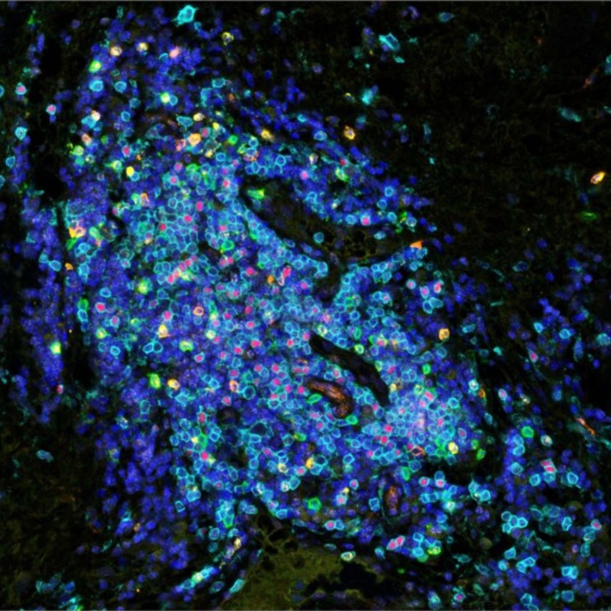 AkoyaBio's tweet image. Discover how teams from the @univbordeaux and @Sorbonne_Univ_ used our #PhenoImager solution for #multiplexed #immunohistofluorescence in a study to explore #tertiarylymphoidstructures (TLSs) found in soft-tissue #sarcomas. go.nature.com/3akn3TY 

#SarcomaAwarenessmonth
