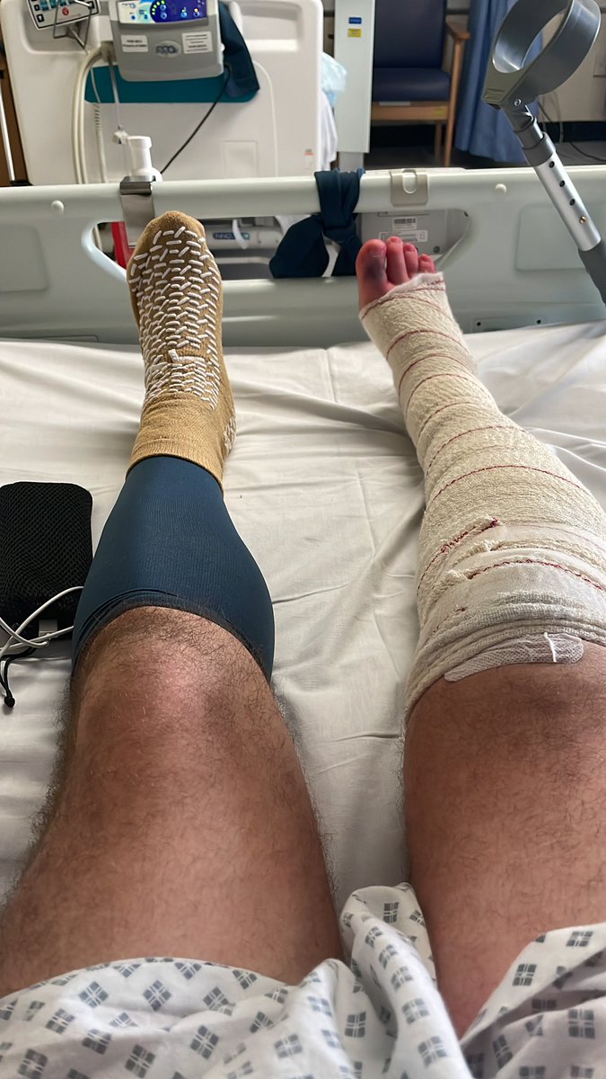 SteveP_1975's tweet image. Following a freak accident playing footy on Tuesday resulting in a broken Tib and Fib, had the most amazing care by great healthcare professionals at SWBH and Newton 3.  Thank you @SWBHnhs @NHSBeeky @salterscottj @DarenFradgley  @MelR4970