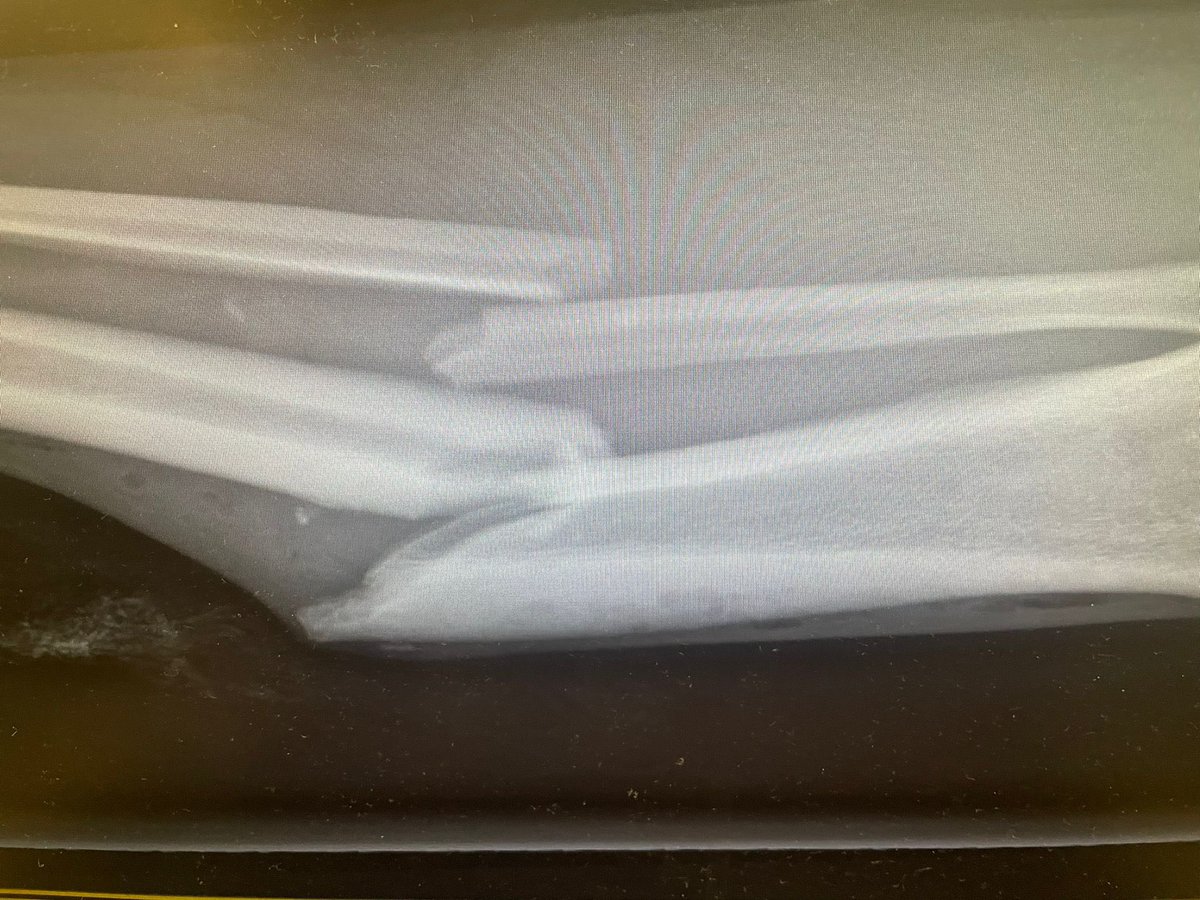 SteveP_1975's tweet image. Following a freak accident playing footy on Tuesday resulting in a broken Tib and Fib, had the most amazing care by great healthcare professionals at SWBH and Newton 3.  Thank you @SWBHnhs @NHSBeeky @salterscottj @DarenFradgley  @MelR4970