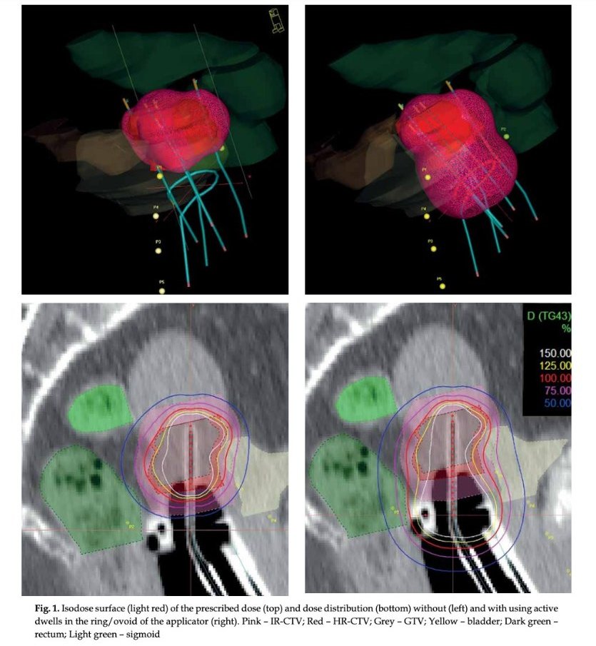 JContBrachyther's tweet photo. Reducing dose to OARs, especially to the vaginal wall, without compro- mising the dose coverage of the target volumes carries itself the promise of reducing the development of rectal fistula and vaginal stenosis, and therefore contribute to preservation
https://t.co/EVjE6aiAaH https://t.co/hOdMkzrGMn