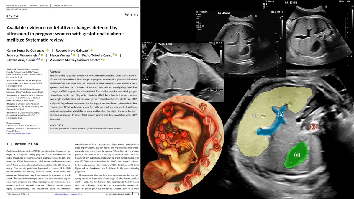 Mais um artigo multidisciplinar resultado da Rede UFSC de Saúde Digital

Acabamos de publicar uma pesquisa acerca da evidência ultrassonográfica de alterações hepáticas fetais visíveis na ultrassonografia obstétrica: doi.org/10.1002/jcu.23…

#ultrassom #obstetricia #diabetes #IA