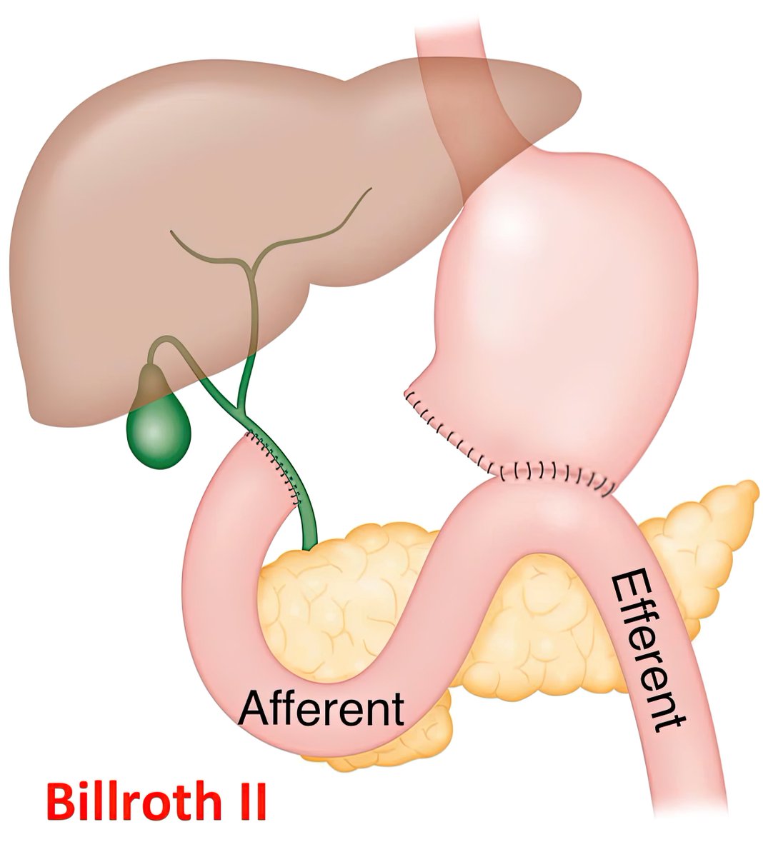 Keith Siau (@drkeithsiau) on Twitter photo <a href="/Kalimul92488767/">Dr kalimullah monir MDکلیم الله منیر</a> Reminder of the Billroth operations 🧠
Billroth 1️⃣ = 1️⃣ limb
Billroth 2️⃣ = 2️⃣ limbs <a href="/Kalimul92488767/">Dr kalimullah monir MDکلیم الله منیر</a> Reminder of the Billroth operations 🧠
Billroth 1️⃣ = 1️⃣ limb
Billroth 2️⃣ = 2️⃣ limbs