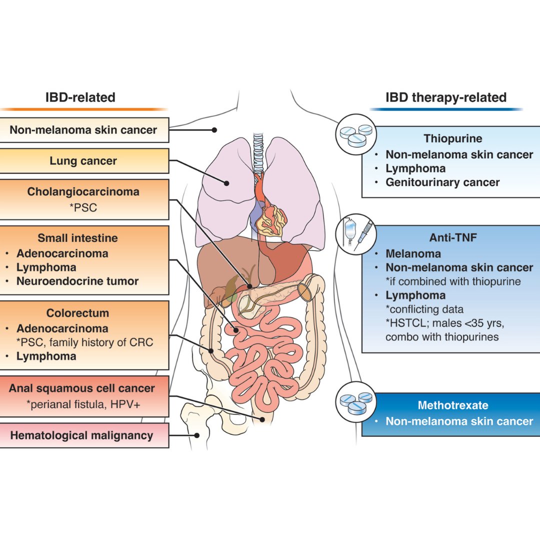 American Gastroenterological Association (AGA) (@amergastroassn) on Twitter photo 📣 Check out our latest clinical practice update in <a href="/AGA_Gastro/">Gastroenterology</a> from <a href="/DrJordanAxelrad/">Jordan Axelrad, MD, MPH</a>, <a href="/JHashashMD/">Jana G Hashash, MD, MSc</a> and Dr. Steven Itzkowitz on the management of malignancies in IBD.
ow.ly/v5uX50SyXrG 📣 Check out our latest clinical practice update in <a href="/AGA_Gastro/">Gastroenterology</a> from <a href="/DrJordanAxelrad/">Jordan Axelrad, MD, MPH</a>, <a href="/JHashashMD/">Jana G Hashash, MD, MSc</a> and Dr. Steven Itzkowitz on the management of malignancies in IBD.
ow.ly/v5uX50SyXrG