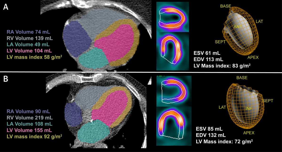 CT Attenuation Correction (CTAC) – Beyond just #CAC? #AI-based CTAC derivation can accurately estimate cardiac volumes and mass to improve risk assessment from attenuation maps in hybrid SPECT-CT imaging. bit.ly/3Ln3PMK

#JACCIMG #MMI #CVnuc #YesCCT