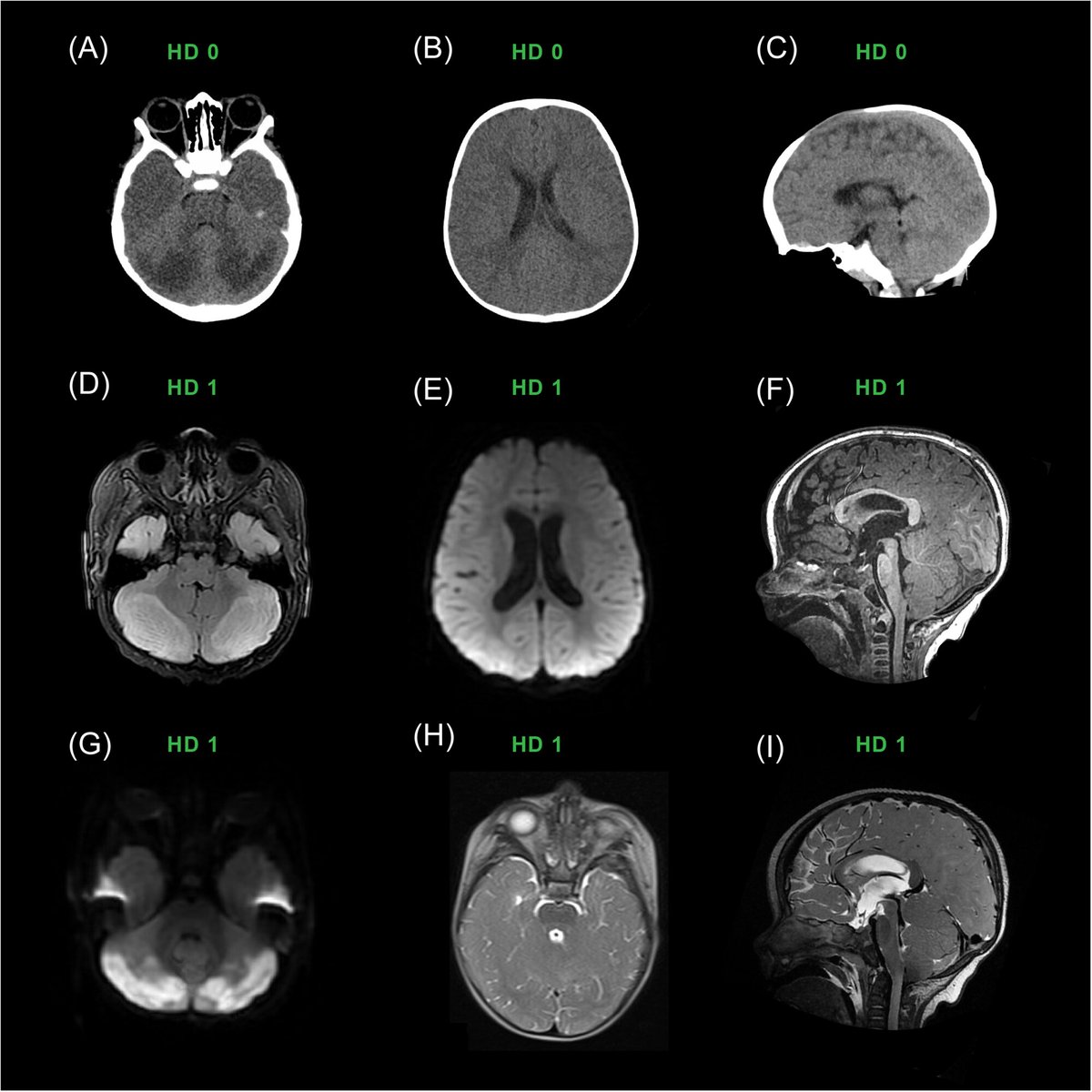 Annals of the Child Neurology Society (@annalscns) on Twitter photo NEW #OpenAccess: #Opioid #neurotoxicity: A case series and review from members of the Child Neurology Society Neurocritical Care Special Interest Group: onlinelibrary.wiley.com/doi/10.1002/cn…
@ImaniSweatt <a href="/DrAnielaG/">Aniela Grzezulkowska, MD</a> <a href="/AaronGelinne/">Aaron Gelinne, MD</a> <a href="/divakarmithal/">divakarmithal</a> <a href="/QuinseyCarolyn/">Carolyn Quinsey</a> <a href="/WileyNeuro/">Wiley Neuro</a> <a href="/ChildNeuroSoc/">Child Neurology Society</a> NEW #OpenAccess: #Opioid #neurotoxicity: A case series and review from members of the Child Neurology Society Neurocritical Care Special Interest Group: onlinelibrary.wiley.com/doi/10.1002/cn…
@ImaniSweatt <a href="/DrAnielaG/">Aniela Grzezulkowska, MD</a> <a href="/AaronGelinne/">Aaron Gelinne, MD</a> <a href="/divakarmithal/">divakarmithal</a> <a href="/QuinseyCarolyn/">Carolyn Quinsey</a> <a href="/WileyNeuro/">Wiley Neuro</a> <a href="/ChildNeuroSoc/">Child Neurology Society</a>