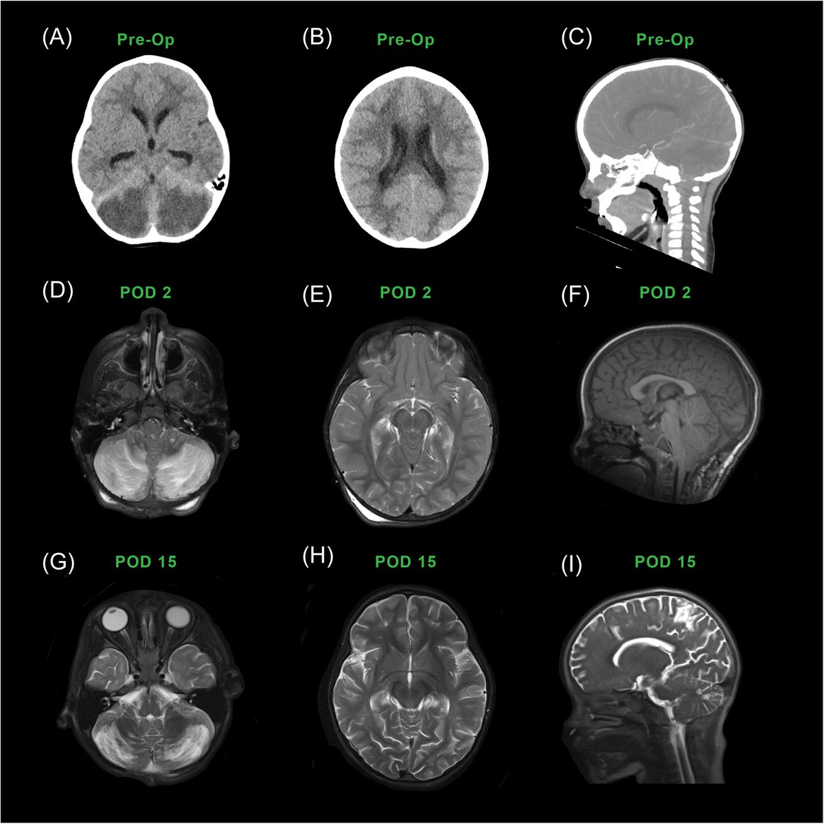 Annals of the Child Neurology Society tweet media