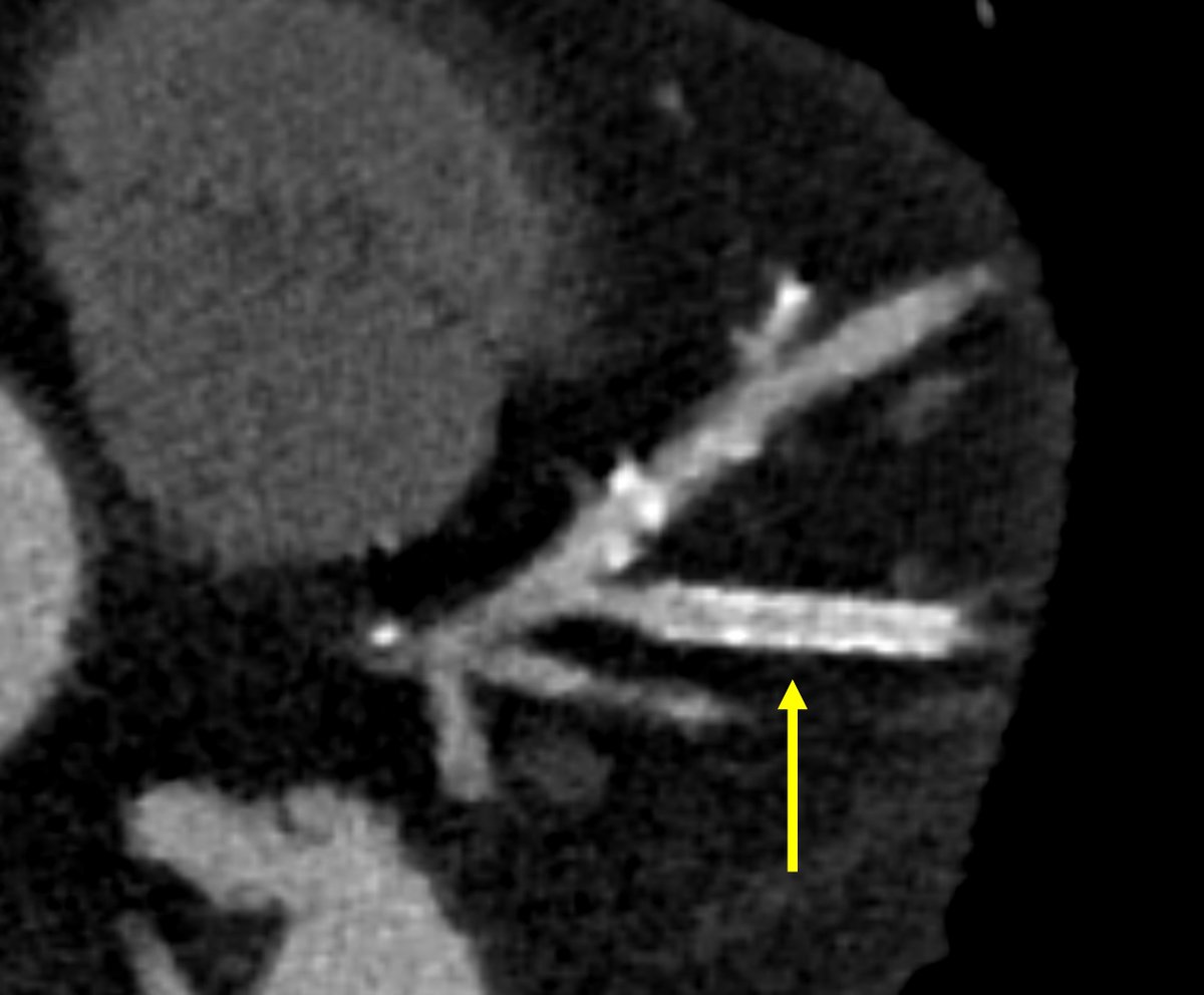 CardiacMadrid's tweet photo. The stent in this branch has reestenosis? https://t.co/xxNxOqkbBk