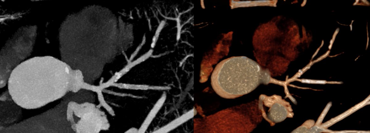 CardiacMadrid's tweet photo. The plaque burden of the patient was extensive. Based on all the imaging findings in this spectral map and VR images. What is your final diagnosis? https://t.co/e5J6ariZBl