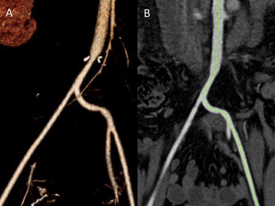 Hamza Hanif (@hamzahanifmd) on Twitter photo Iliac Transposition Technique for Reconstruction of Aortic Bifurcation in Pediatric Blunt Abdominal Aortic Injury
<a href="/JVascSurgCIT/">JVS-Cases Innovations and Techniques</a> <a href="/RichMiskiminsMD/">Richard Miskimins</a> <a href="/alirana1/">Muhammad Ali Rana</a>
jvscit.org/article/S2468-… Iliac Transposition Technique for Reconstruction of Aortic Bifurcation in Pediatric Blunt Abdominal Aortic Injury
<a href="/JVascSurgCIT/">JVS-Cases Innovations and Techniques</a> <a href="/RichMiskiminsMD/">Richard Miskimins</a> <a href="/alirana1/">Muhammad Ali Rana</a>
jvscit.org/article/S2468-…