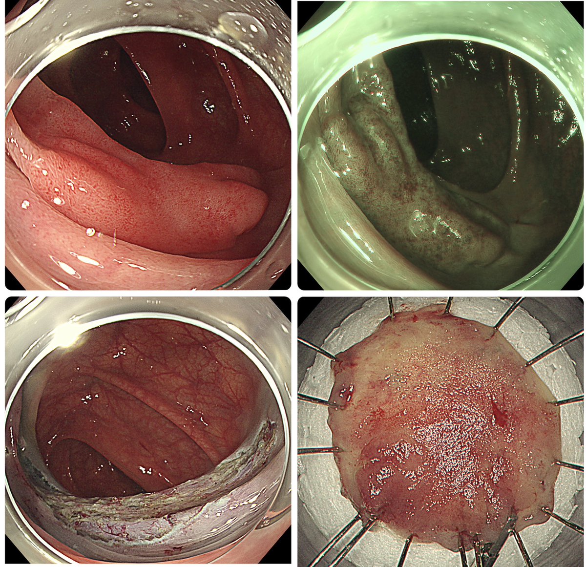 ben_sukit's tweet photo. My 50th ESD for this year. Hope to do 100 a year smoothly and keep learning 💪✌️

#Colochula #SurgicalEndoscopyChula #EndoscopicSubmucosalDissection #ESD #ColonPolyp https://t.co/SCdMuNw3zY
